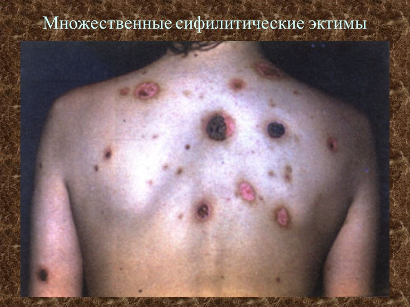 Множественные сифилитические эктимы